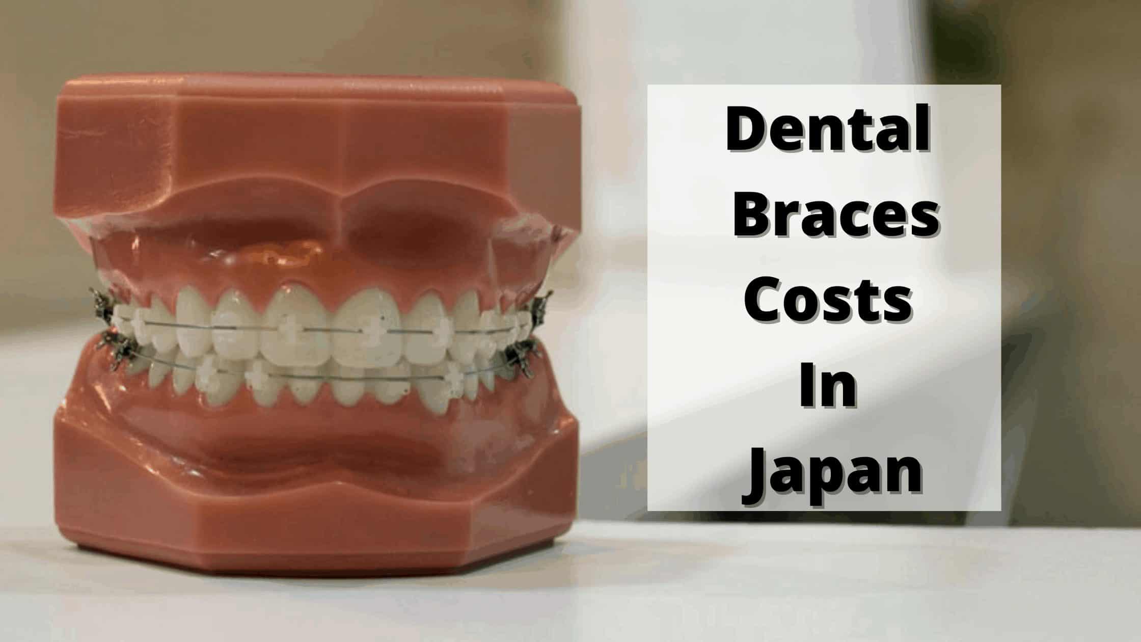 What are Dental Braces Costs In Japan 2021? Japan Truly