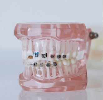 Coste de la ortodoncia en Japón