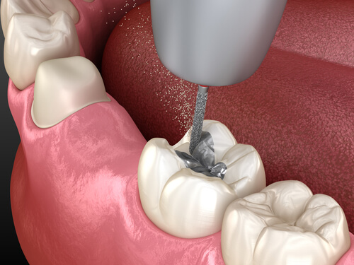 DENTAL FILLINGS IN JAPAN