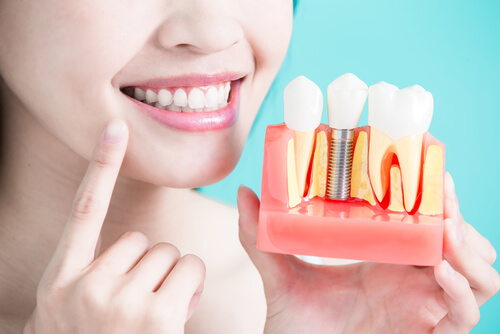 coste de los implantes dentales en Japón