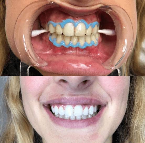 teeth whitening clinics in Japan