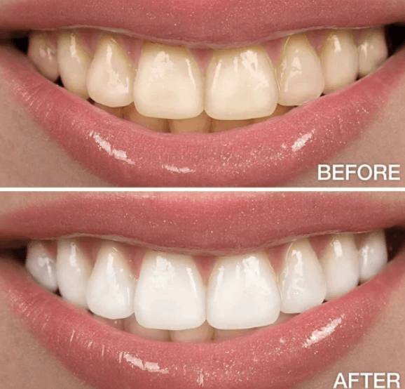 teeth whitening japan