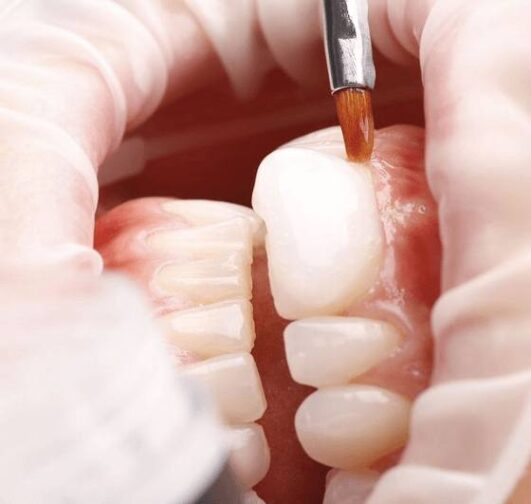 3 Types Of Teeth Whitening In Japan Clean And Hygienic Teeth Japan